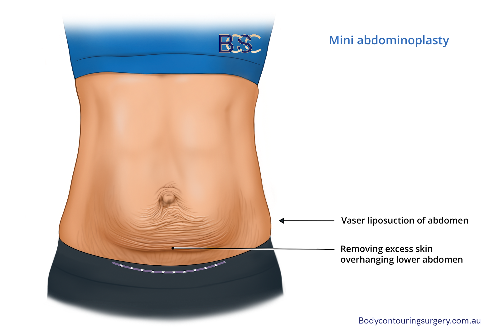 Illustration of Mini Abdominoplasty