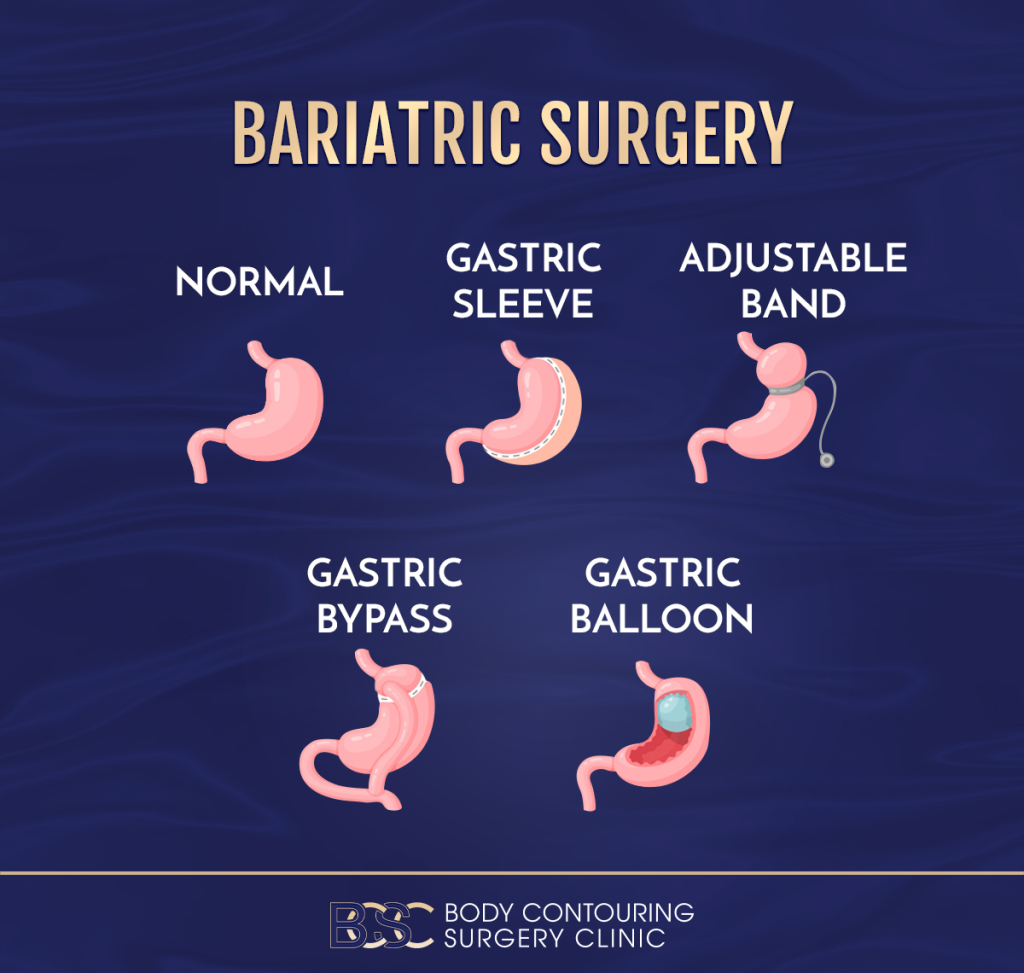 Bariatric Surgery - Body Contouring