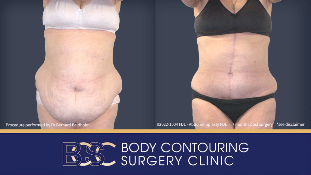 Fleur de lis abdominoplasty | BCSC