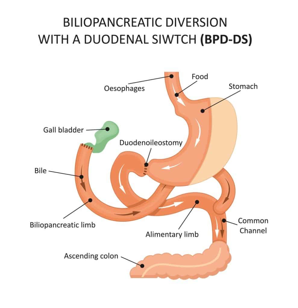 Biliopancreatic Diversion with Duodenal Switch