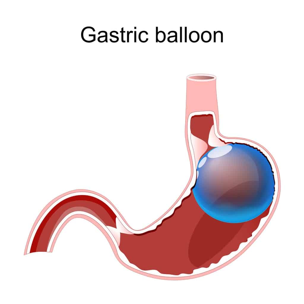 Gastric Balloon