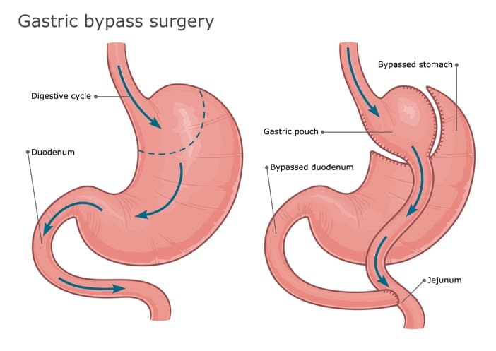 Gastric by-pass surgery illustration