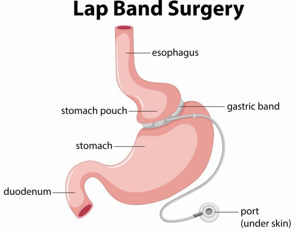 Lap Band Surgery