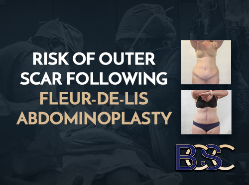 Risk of Outer Scar Following Fleur-de-Lis Surgery (Tummy Tuck)