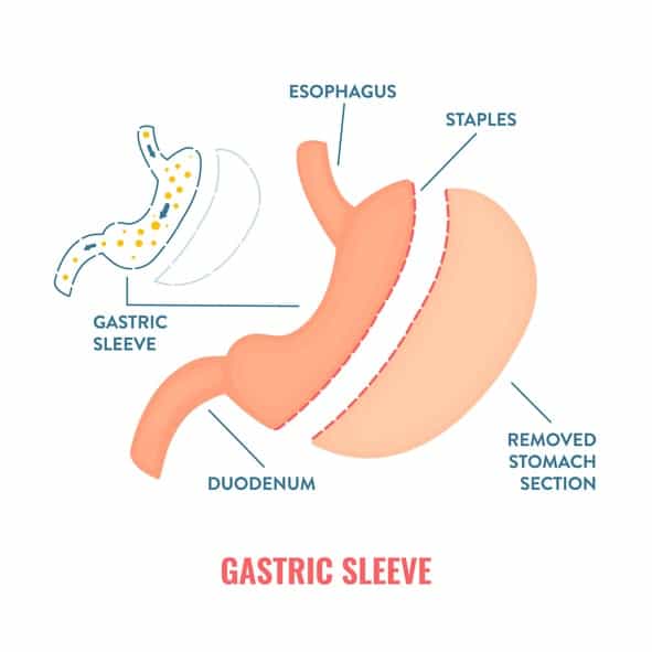 Gastric sleeve surgery