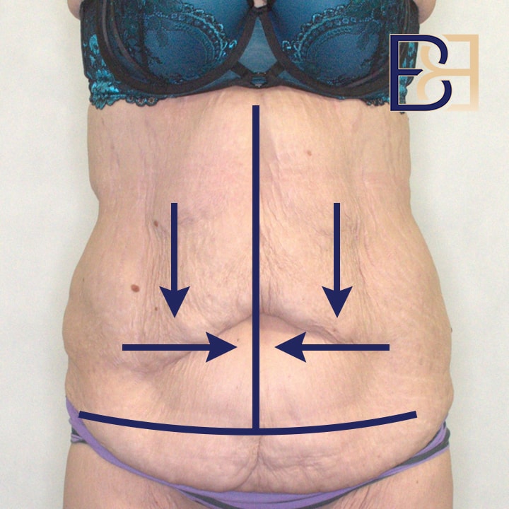 Treating excess horizontal and vertical skin with a Fleur de lis abdominoplasty | Dr Beldholm