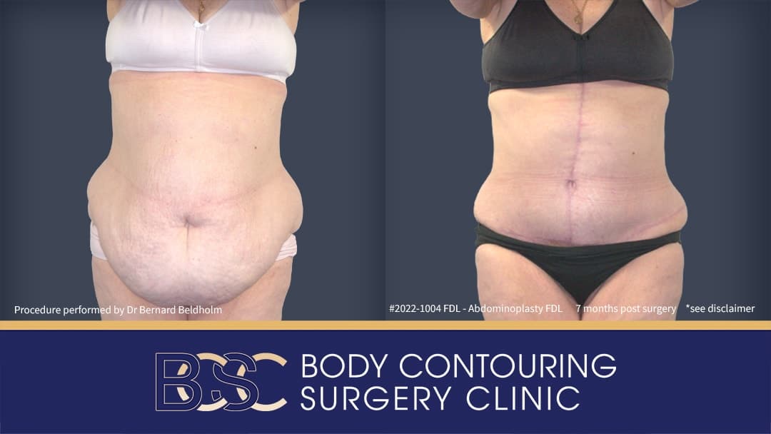 Before and after fleur de lis abdominoplasty