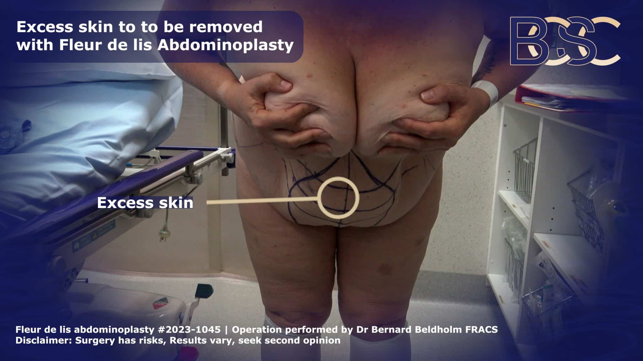 Excess skin to remove |  | BCSC