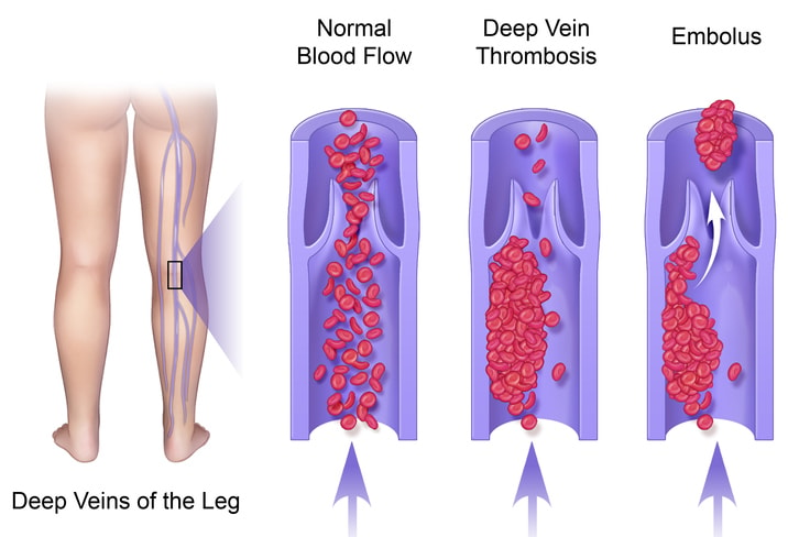 DVT after surgery