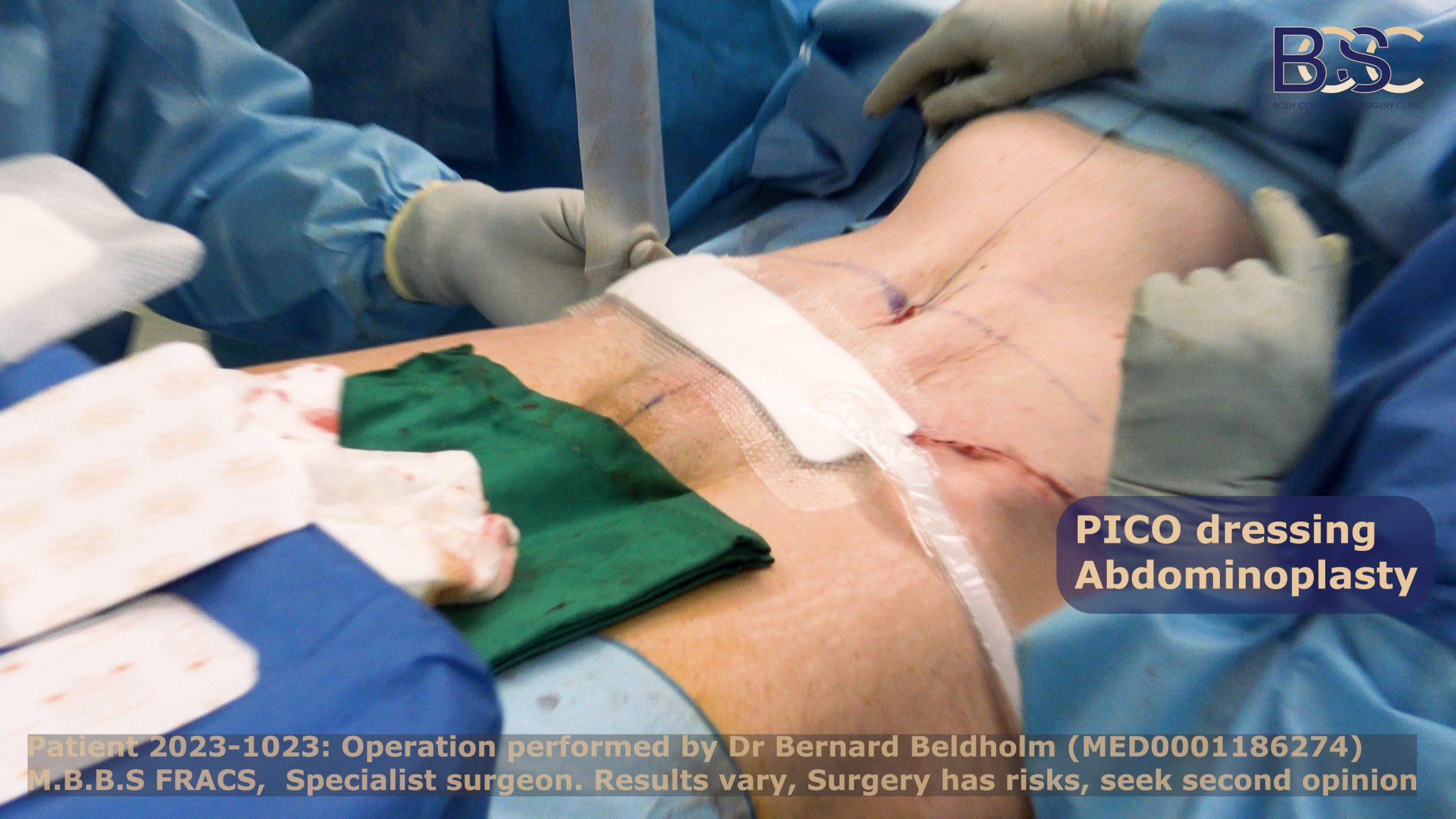 PICO dressings applied after surgery | Dr Beldholm