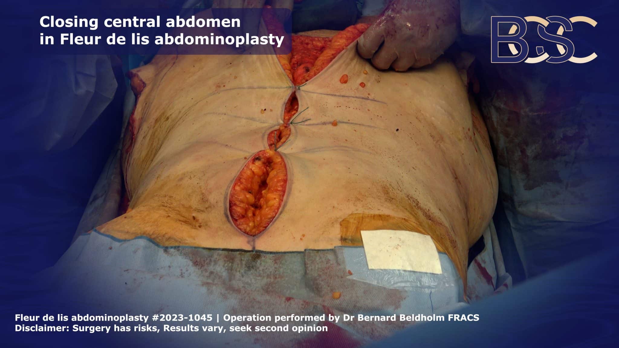 Vertical incision of a fleur de lis abdominoplasty | BCSC