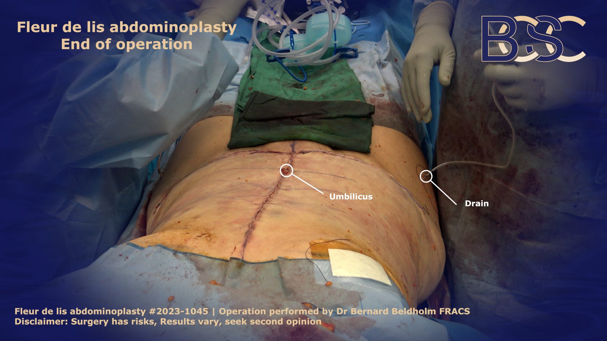 Fleur de lis abdominoplasty end of operation showing incisions | BCSC