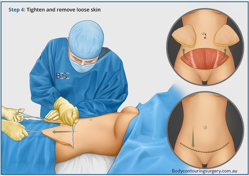 Lower abdominal incision lines | Dr Beldholm