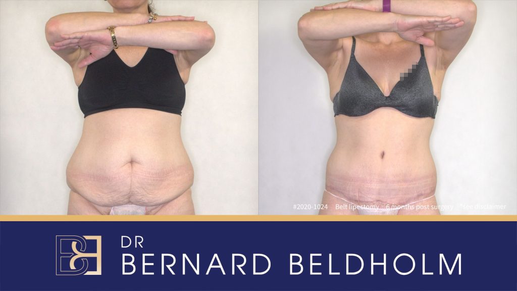 Belt lipectomy | Dr Beldholm