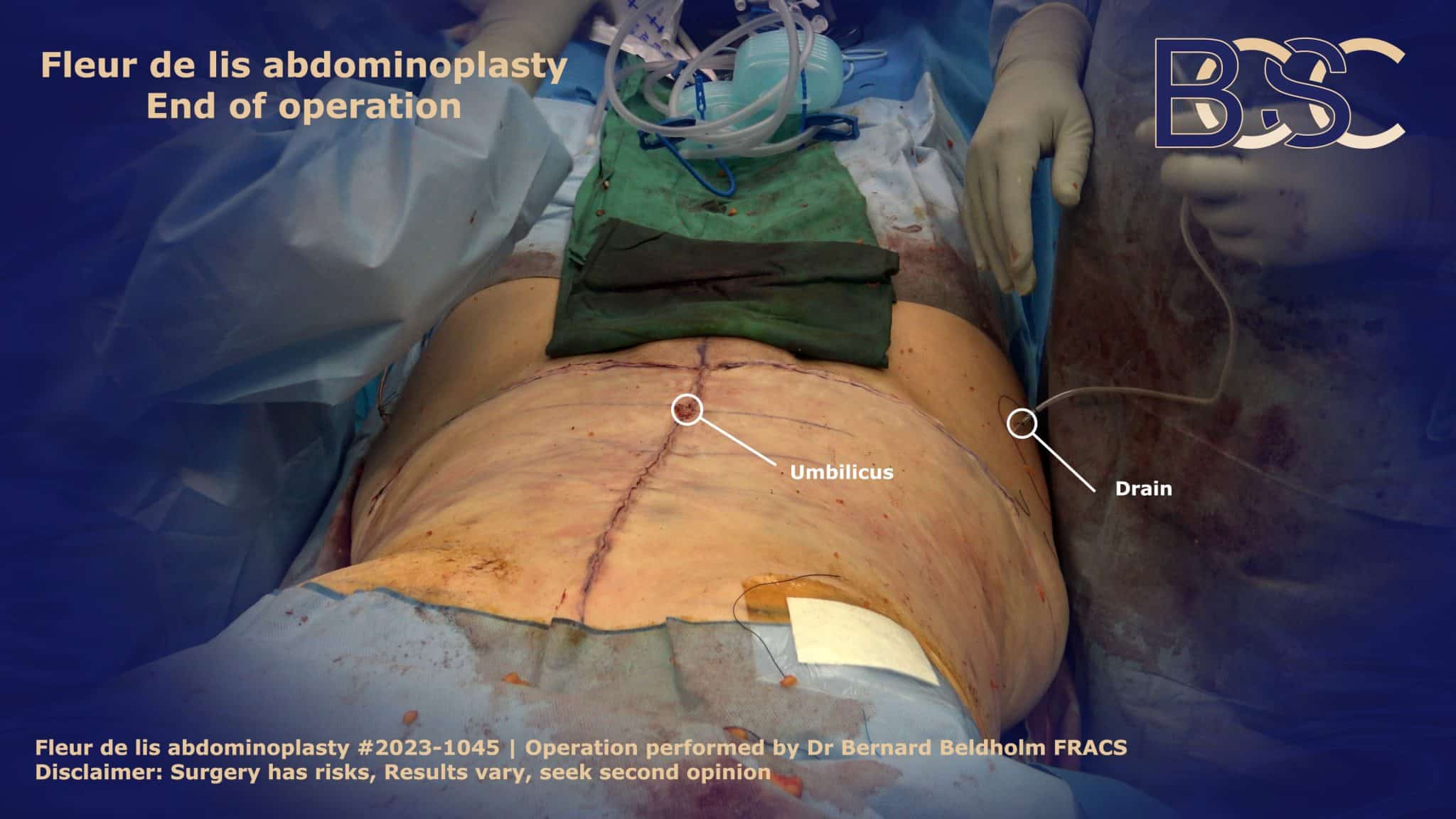 Fleur de Lis Tummy Tuck (Abdominoplasty) Incisions | BCSC