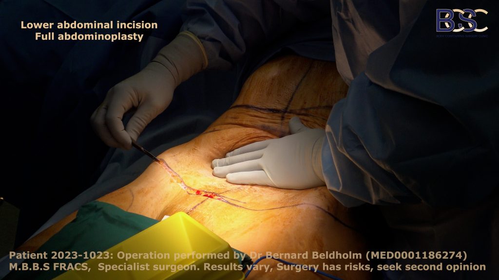 Initial abdominoplasty incision, operation performed by Dr Beldholm