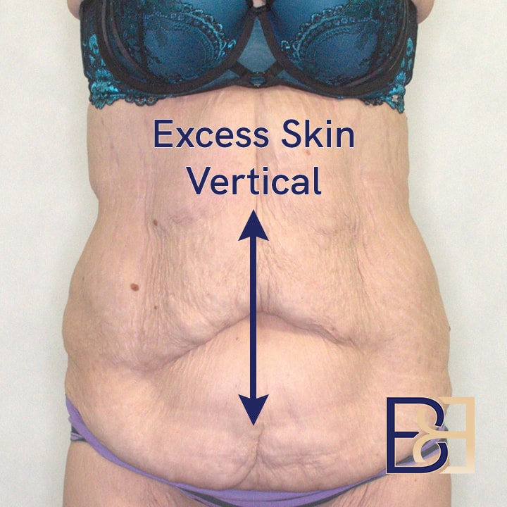 Excess vertical skin | Dr Beldholm