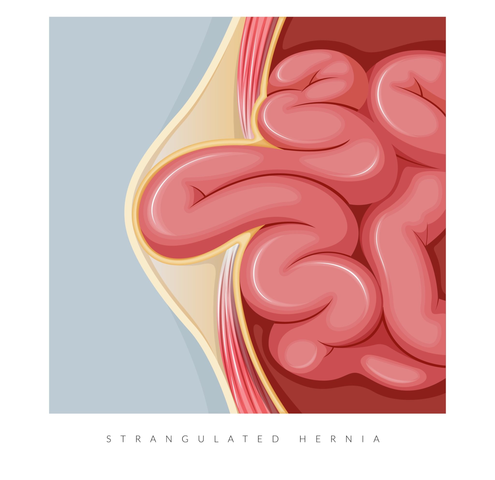 What is an Umbilical Hernia?