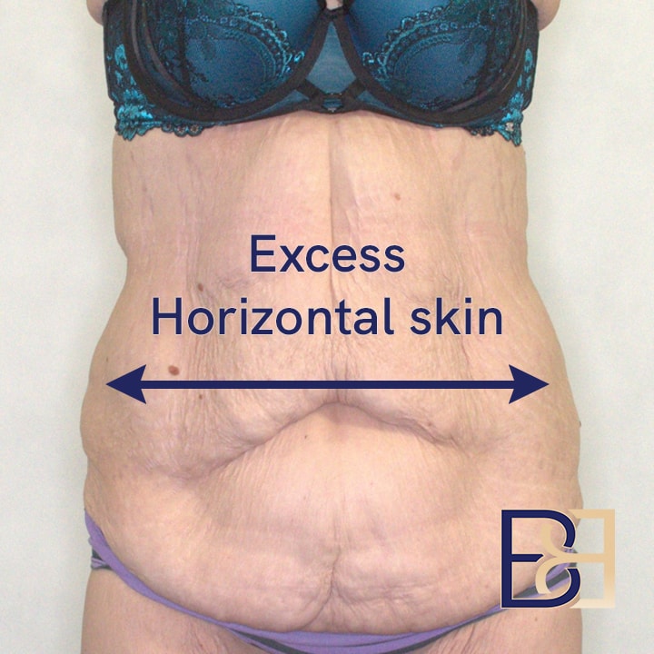 Horizontal excess skin on the abdomen | Dr Beldholm