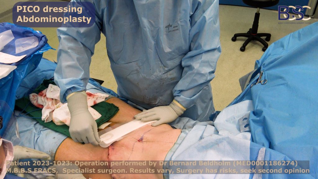 PICO dressings at the end of the operation | Dr Beldholm

