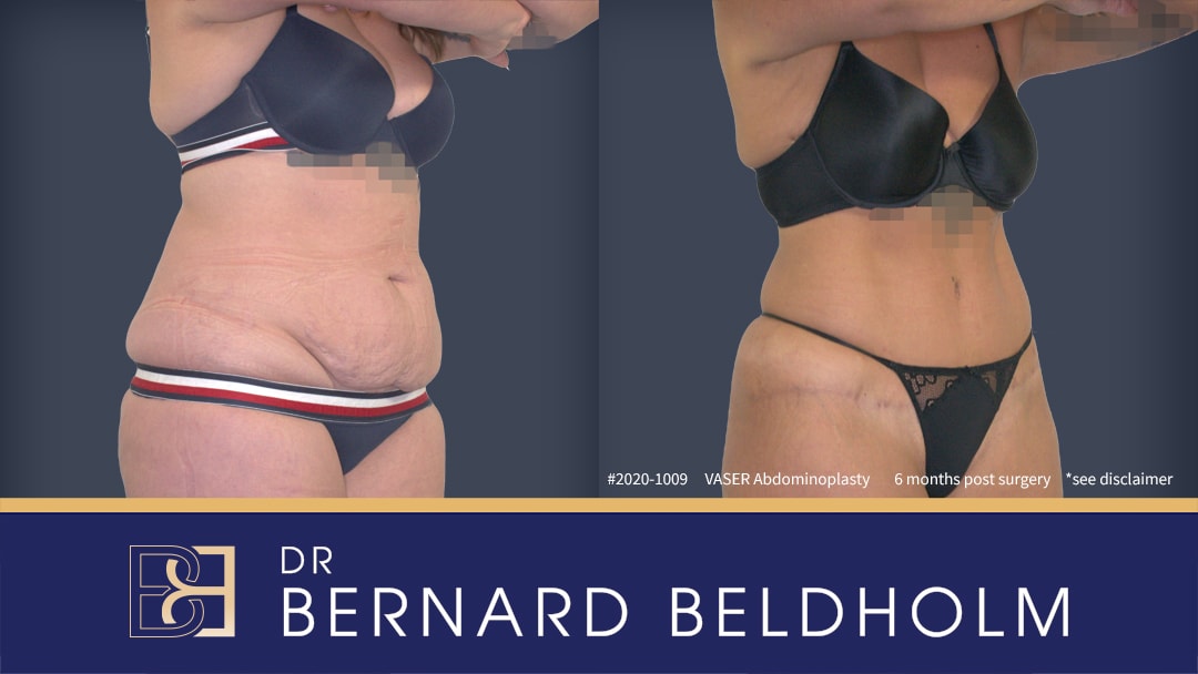 Full abdominoplasty by Dr Beldholm | BCSC