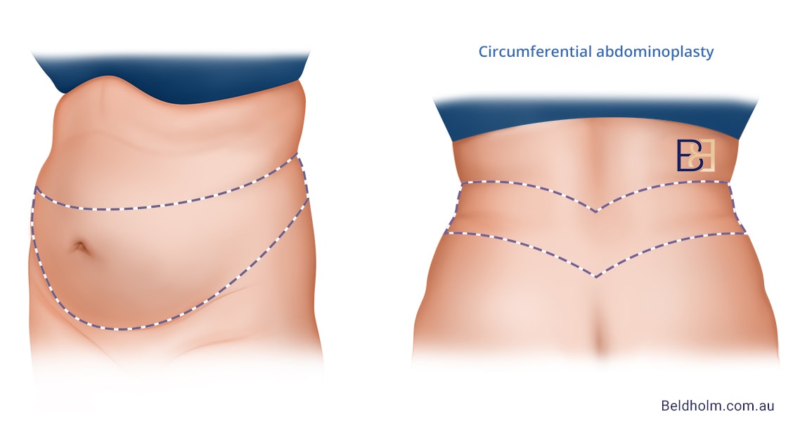 Belt lipectomy illustration | Dr Bernard Beldholm