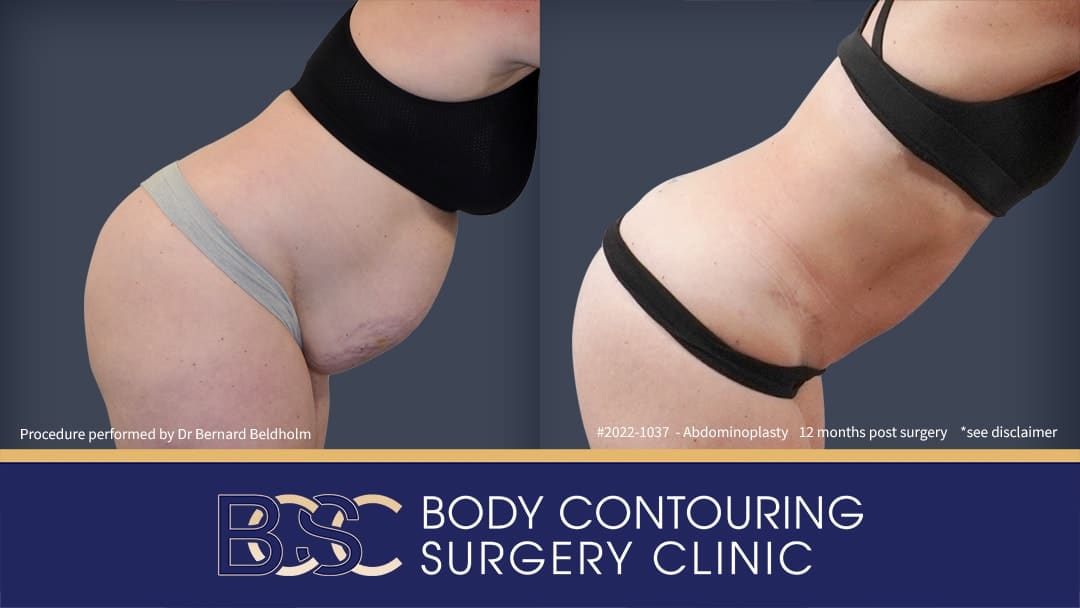 Extended abdominoplasty | Operation performed by Dr Bernard Beldholm