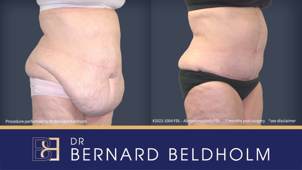 Fleur de lis abdominoplasty by Dr Beldholm | BCSC