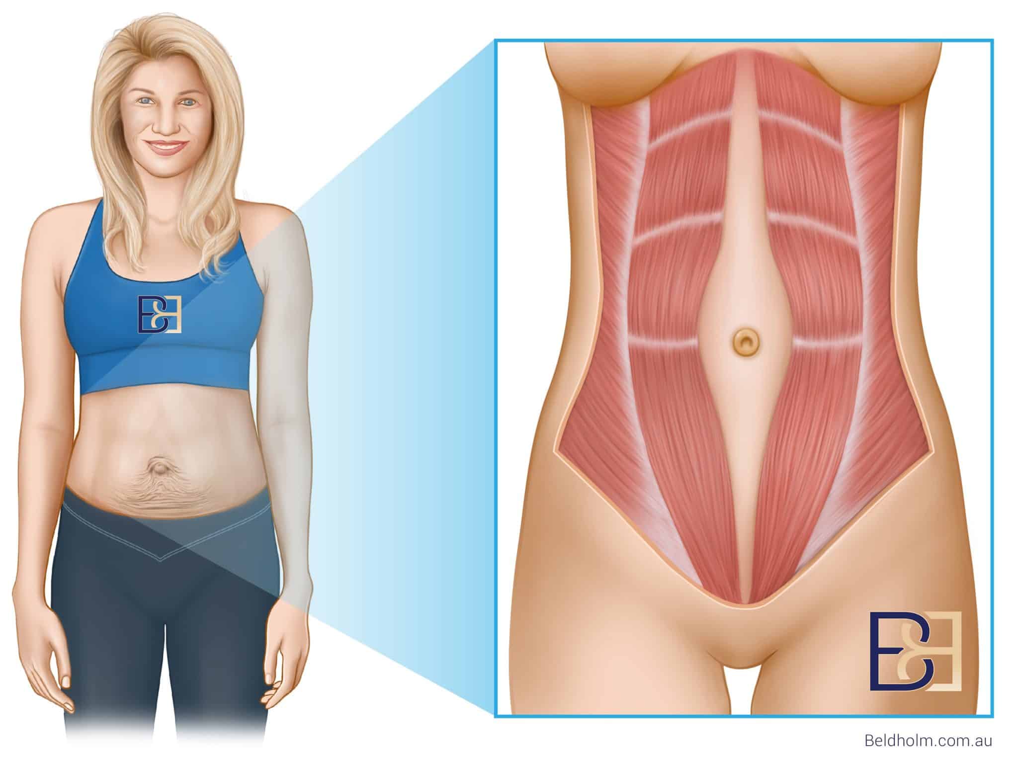 separated abdominal muscle repair