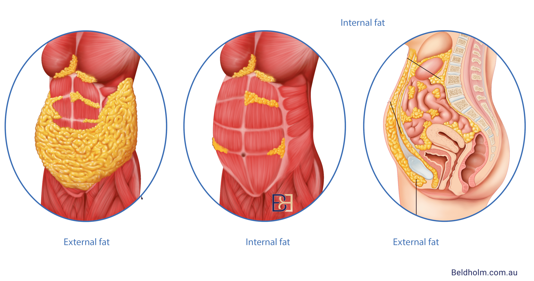 Internal fat can not be treated with body contouring surgery. Weight loss is the primary method for removing this.