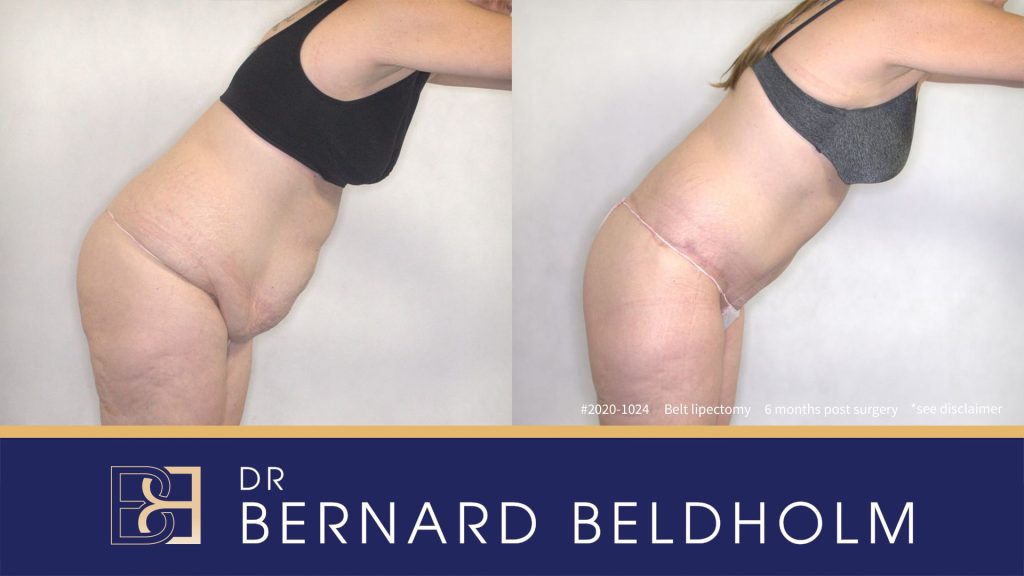 Belt lipectomy performed by Dr Bernard Beldholm