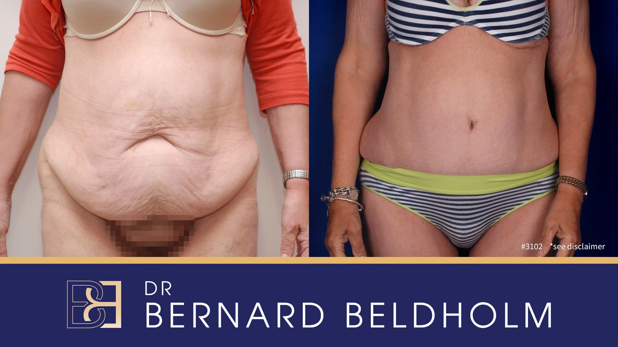 Abdominoplasty after massive weight loss | Operation performed by Dr Beldholm