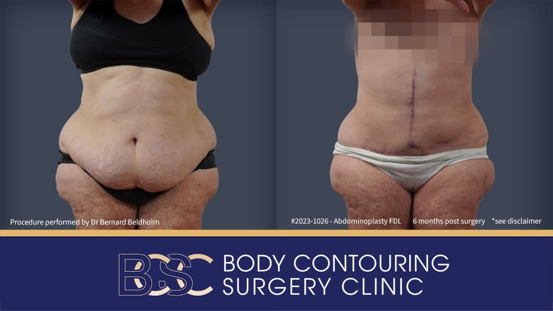 Fleur de lis abdominoplasty | vertical and Horizontal incisions | performed by Dr Beldholm