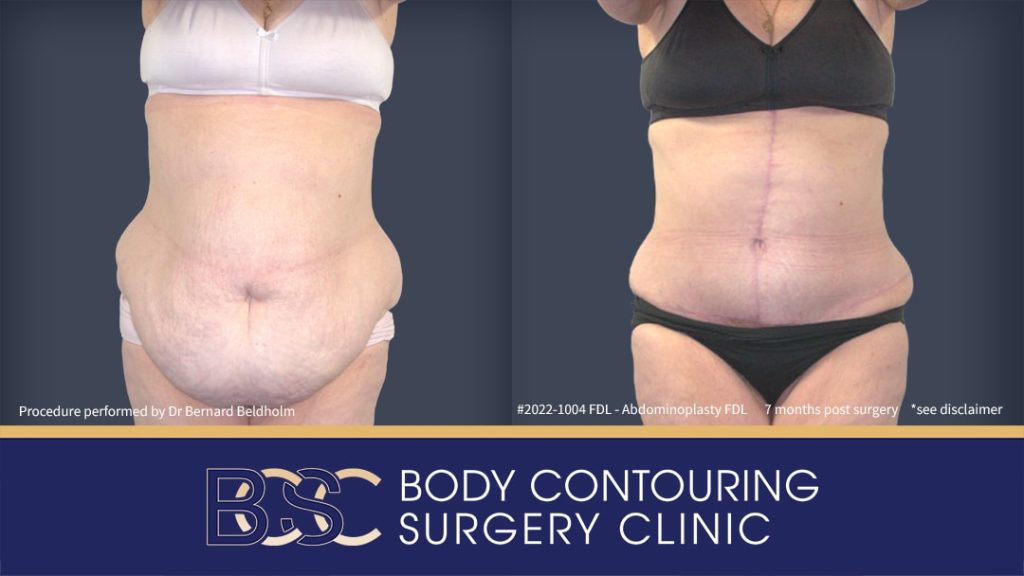 Fleur de lis abdominoplasty by Dr Bernard Beldholm | BCSC