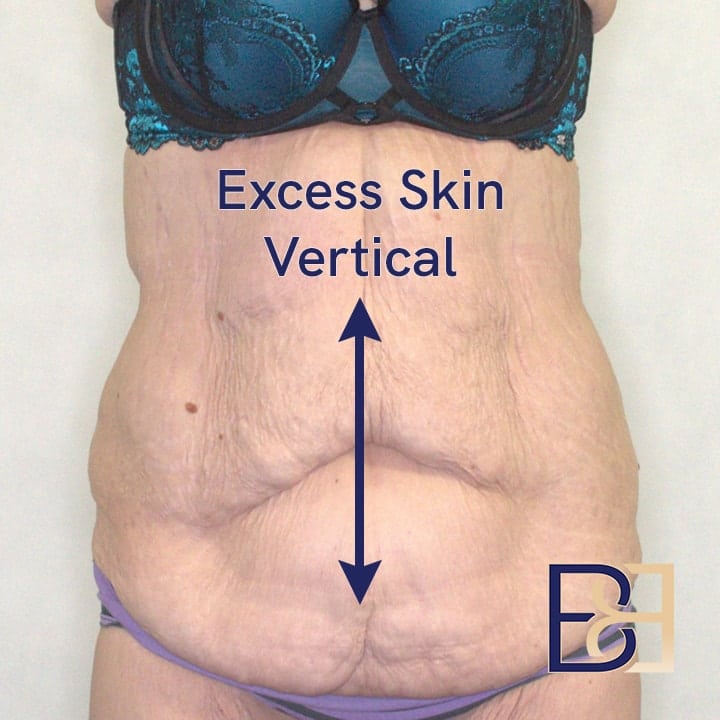 Excess vertical skin | BCSC