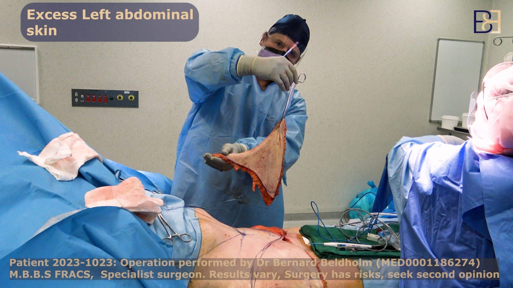 Dr Beldholm removing excess skin