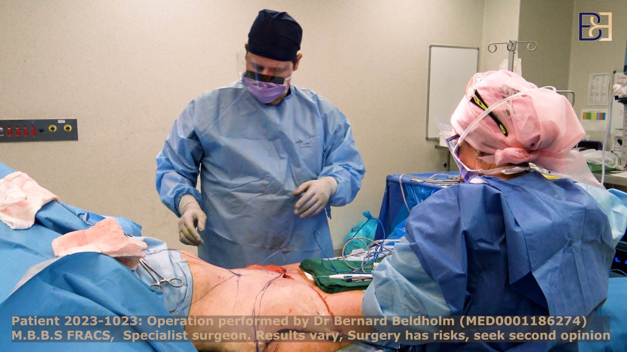 Dr Beldholm performing VASER liposuction during extended tummy tuck