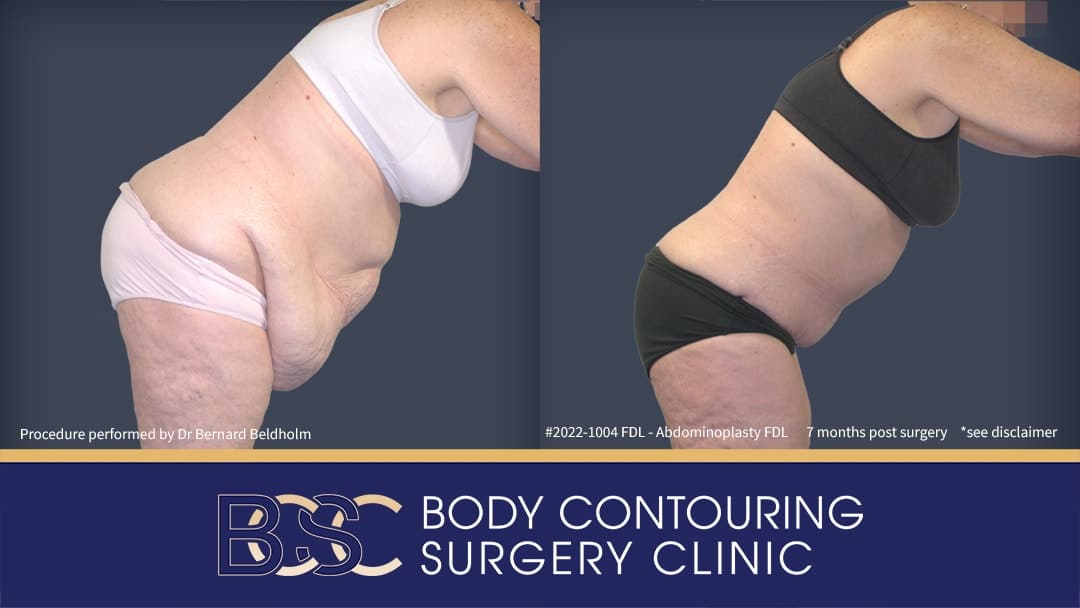 Fleur de lis abdominoplasty Before & After | Operation performed by Dr Bernard Beldholm