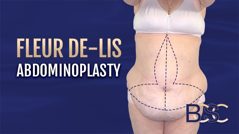 Fleur de lis abdominoplasty excision pattern | BCSC