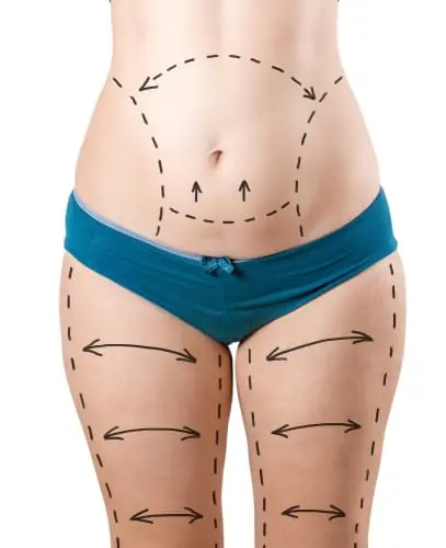 standard tummy tuck and thigh lift