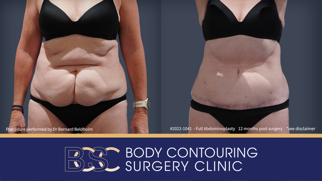 Patient 2022-1041 - Full Tummy Tuck - Before & After