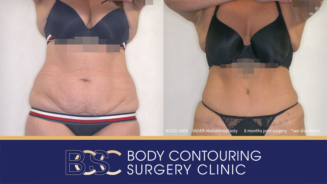 Patient 2020-1009 - VASER Abdominoplasty - Before After - Front