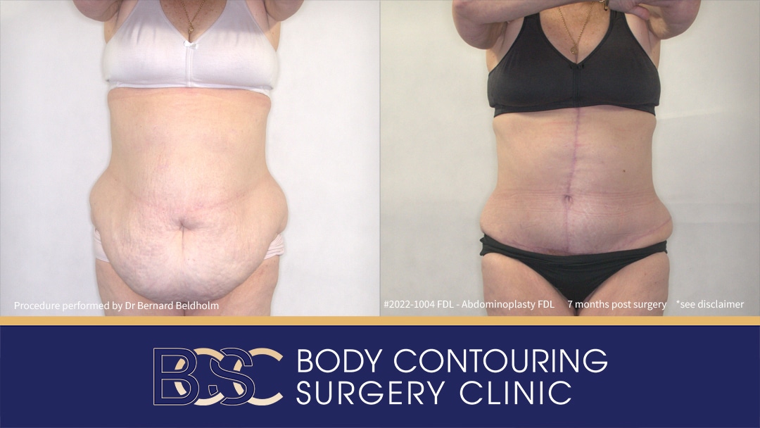 Patient 2022-1004 - Fleur de Lis Abdominoplasty with VASER Liposuction - Front