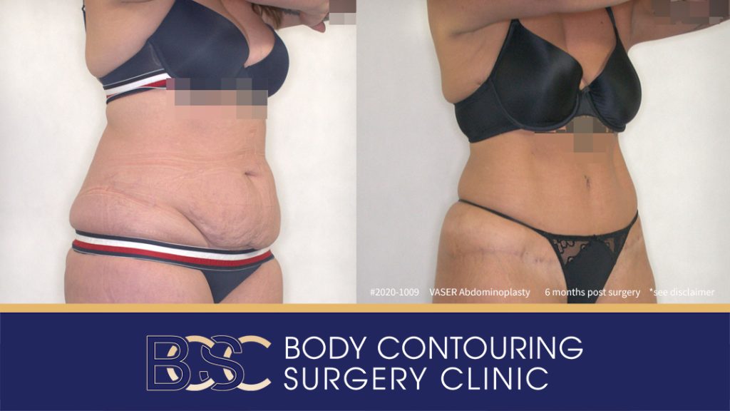 Patient 2020-1009 - VASER Abdominoplasty - Before After - Left