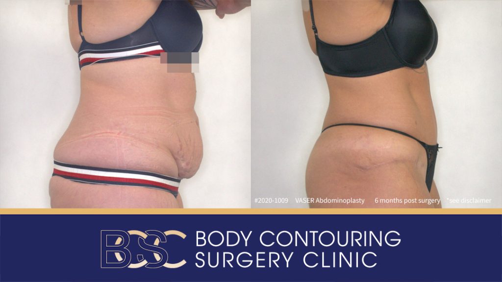 Patient 2020-1009 - VASER Abdominoplasty - Before After - Side