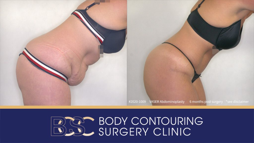 Patient 2020-1009 - VASER Abdominoplasty - Before After - Bend
