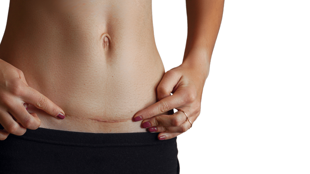 Surgical scars after standard tummy tuck