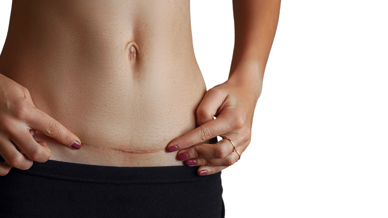 surgical scars after standard tummy tuck