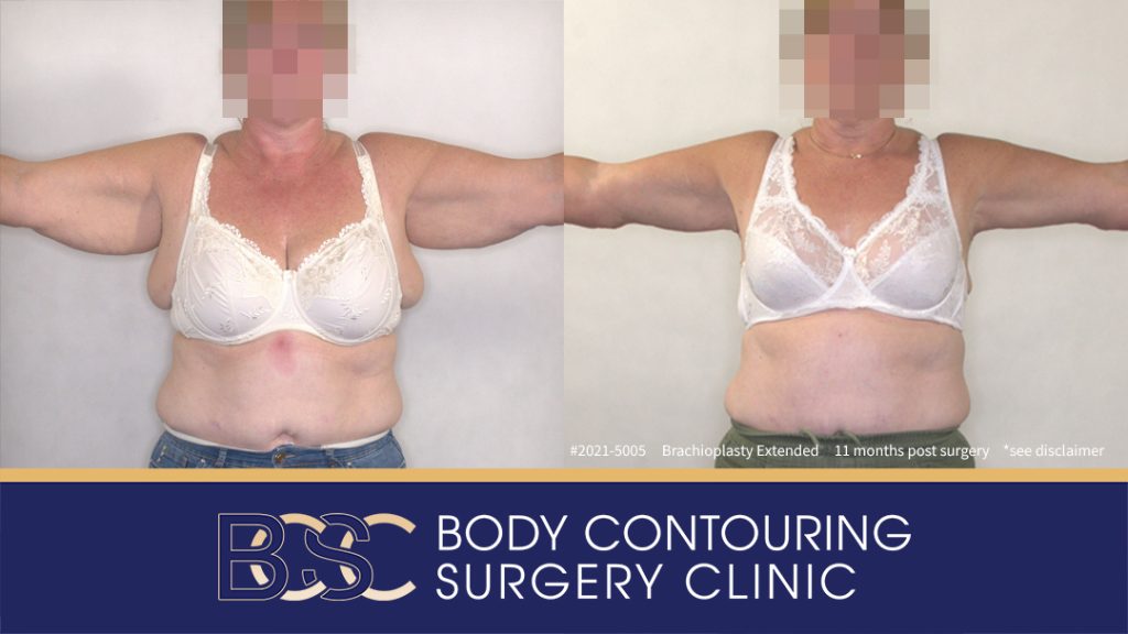 Extended Brachioplasty Assisted by VASER Liposuction (Patient 2021-5005) - Front