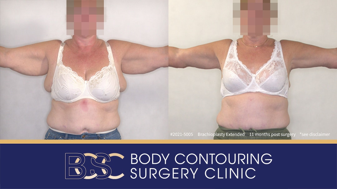 Patient 2021-5005 Extended Brachioplasty Assisted by VASER Liposuction - Front